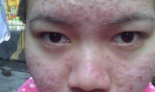 脸上长痘痘该怎么办